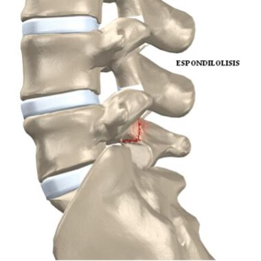 Espondilolistesis lumbar