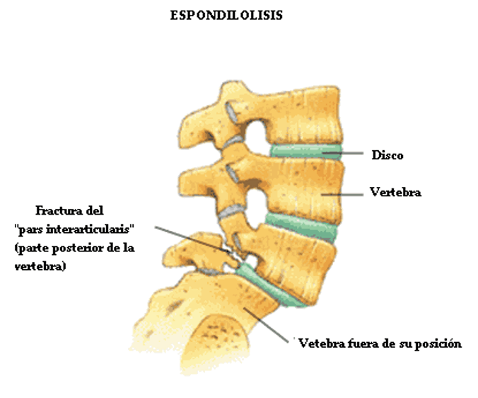 Espondilolistesis lumbar-