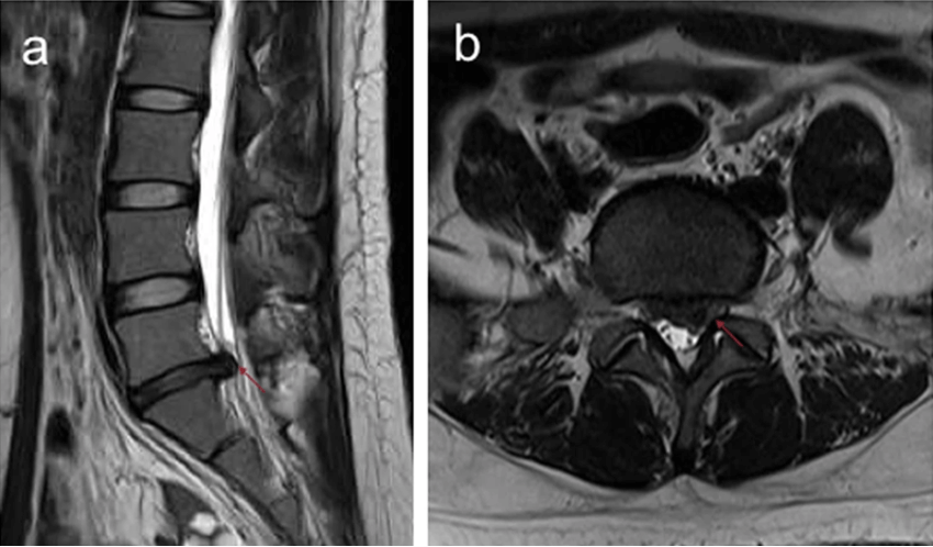 Diagnóstico hernia discal