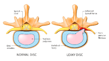 Hernia discal lumbar