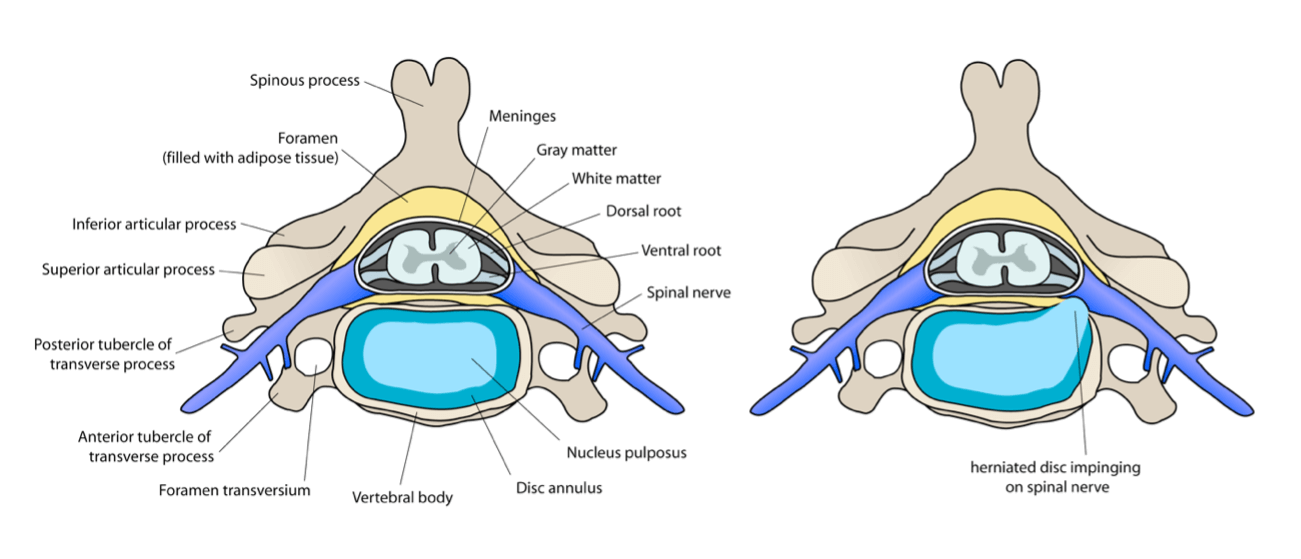 Hernia y protusion discal cervical