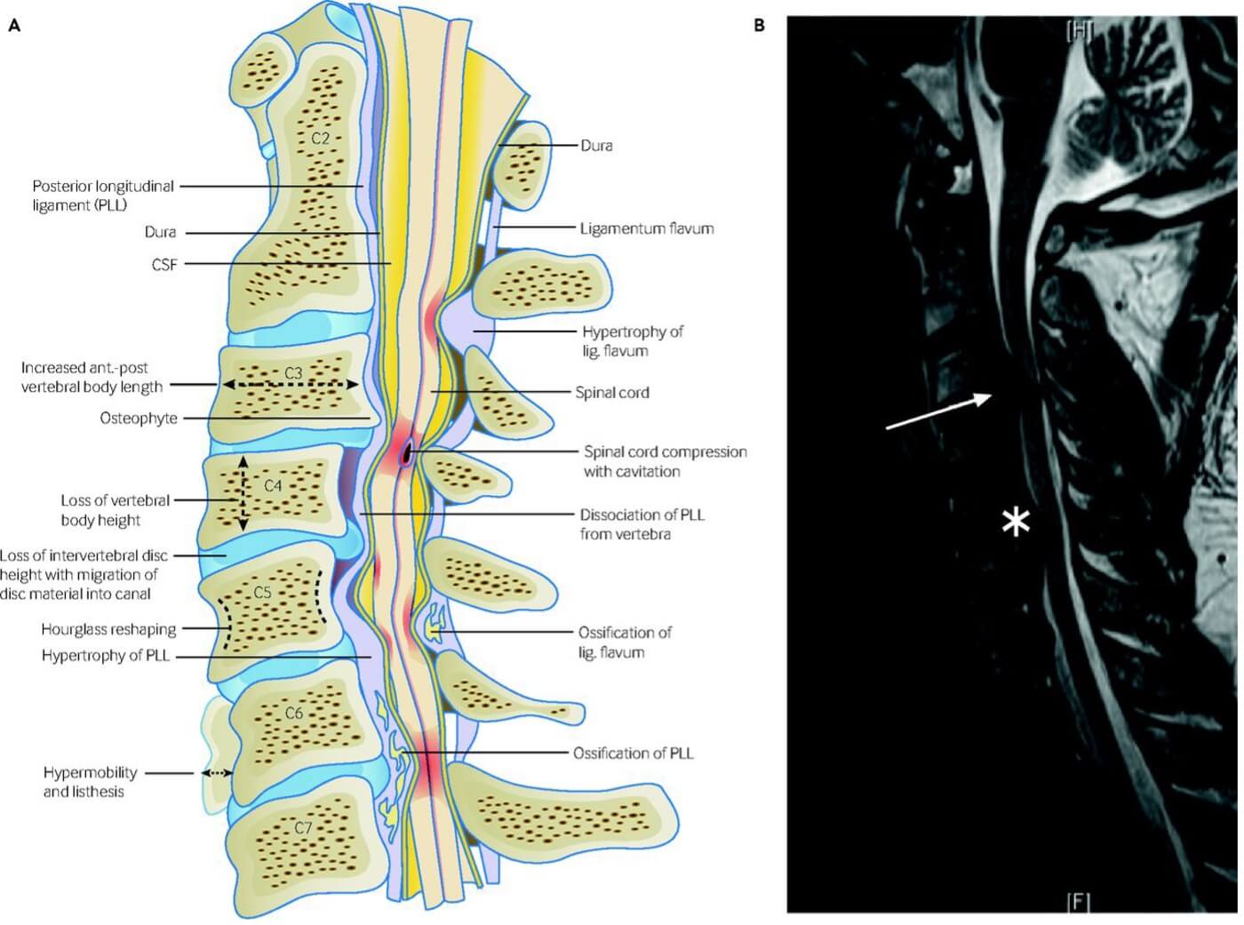 Imagen mielopatía cervical