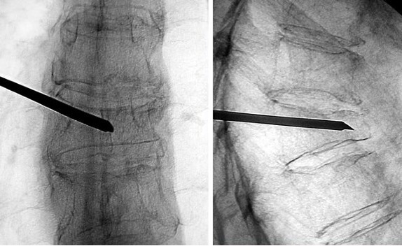 vertebroplastia