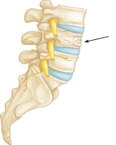 fractura vertebral lumbar