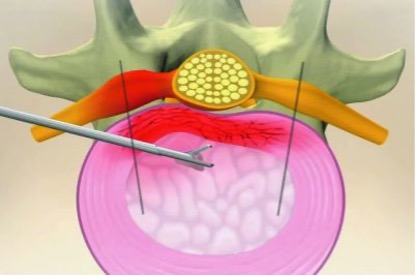 Discectomía percutánea 