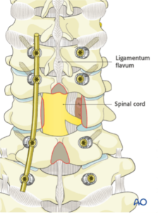 Artrodesis cervical posterior Artrodesis cervical posterior