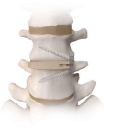 Artrodesis lumbar lateral Artrodesis lumbar lateral