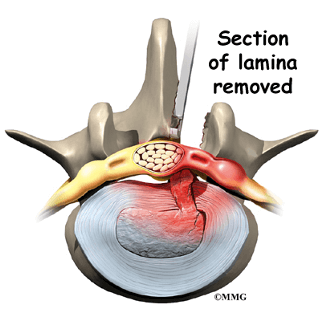 Cirugía de hernia discal lumbar