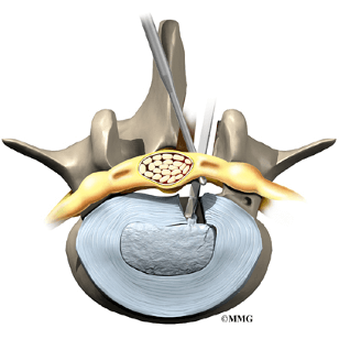 Hernia discal lumbar 